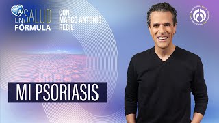 Al menos 60 millones de personas viven con psoriasis… y 25 son mexicanas [upl. by Olette]