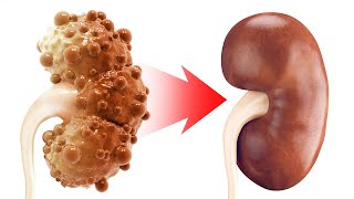 The REAL Cause of Chronic Kidney Disease and Polycystic Kidney Disease [upl. by Perlman]