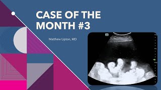 Case of the month 3 how you use POCUS to make your paracentesis even safer [upl. by Fortune]