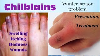 Chilblains  chilblains treatment [upl. by Yehudit]