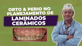 Ortodontia e Periodontia em laminados cerâmicos [upl. by Anastassia]