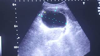 Right ovarian cystultrasound abdomen [upl. by Stout]