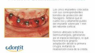 Caso Clínico quotProtocolo Branemark modificadoquot [upl. by Macmillan]