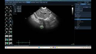 IQ 309 TFAST LUNF MEDIASTINAL LN ENLARGEMENT ASCITES BLOOD LYMPHOMA ULTRASOUND [upl. by Eibocaj]