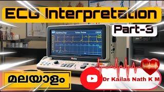 ECG Interpretation Made Easy in Malayalam  Part 3  Cardiac Axis Interpretation [upl. by Nodyarg]