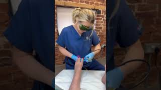 Laser Treatment of Fungal Nail [upl. by Etteval]