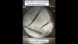 urethral stricture New successful application of Paclitaxel Dextran balloon balloonurethroplasty [upl. by Nikki]