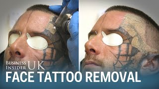 Watch This Man Have His Face Tattoo Removed From Laser Surgery  Business Insider [upl. by Max]