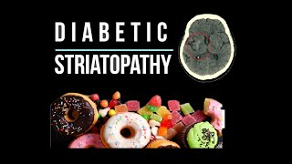 Diabetic striatopathy Nonketotic hyperglycemic hemichorea [upl. by Shamma348]