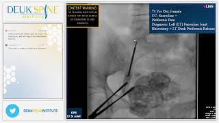 Sacroiliac Joint Rhizotomy for Sacroiliitis [upl. by Euginomod]