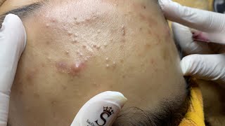 Forehead Acne And Pimples  Mụn Trán  SacDepSpa322 [upl. by Ronyar]