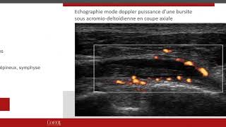 Pseudo polyarthrite rhizomélique Diagnostic 957Pr Clément Prati [upl. by Tamanaha]