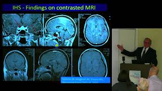 Headaches in the Chiari and EDS Population Fraser C Henderson Sr  MD [upl. by Roselia746]