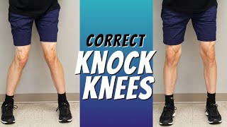 Top 5 Ways to Correct Knock Knees with Exercise Etc [upl. by Rudin]