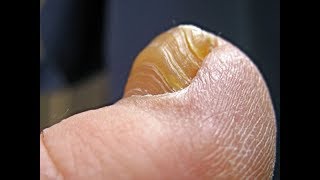 How to Cure Toenail Fungus Fast amp Naturally at Home [upl. by Annehsat]