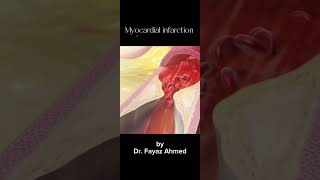 Myocardial Infarction Heart Attack Animated video 😯 [upl. by Bjorn]