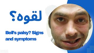 Bells Palsy  Comprehensive Overview of Symptoms and Signs [upl. by Hynes]