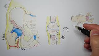 Hematogenous osteomyelitis in children [upl. by Ennovihs]