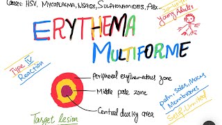 Erythema Multiforme EM causes symptoms treatment  skin disorder [upl. by Retha617]