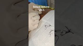 Suture RemoveLSCSMedical With Sanju [upl. by Gabbie]