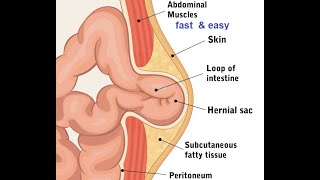 Femoral Umbilical amp Epigastric hernias [upl. by Ardnasyl87]