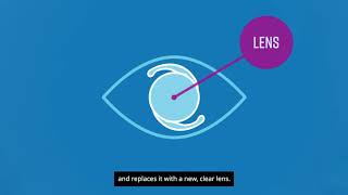 The PanOptix® Lens the first trifocal lens for cataract surgery [upl. by Jasisa]