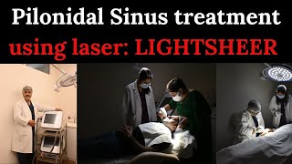 Pilonidal Sinus treatment using laser LIGHTSHEER  Advanced Wellness  laser [upl. by Decca]