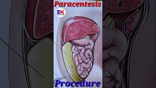 Paracentesis procedures medicineknowledgehindi short [upl. by Castra]