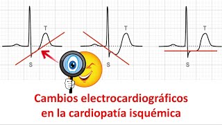 Cambios electrocardiográficos en la cardiopatía isquémica [upl. by Sanbo]