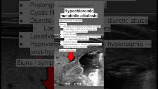 Hypochloremic metabolic alkalosis [upl. by Katy]