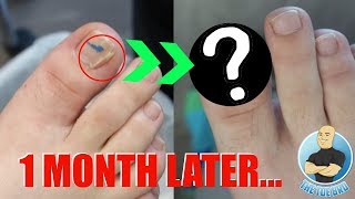 Did the Damaged Split Nail Heal FOOT HEALTH MONTH 2018 19 [upl. by Ahsinrat]