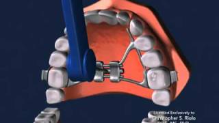 Seattle Orthodontist Dr Christopher Riolo Banded Expander RPE [upl. by Stroup]