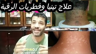 علاج التينيا والفطريات في الرقبة والجسم pityriasis versicolor [upl. by Yllod]