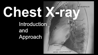 Chest Xray Introduction and Approach [upl. by Mahalia]