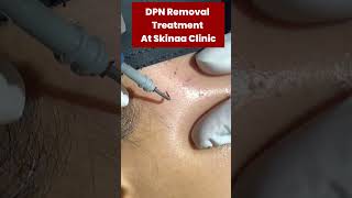 What is DPN and how it’s treated at Skinaa Clinic viral shotrs [upl. by Nima388]