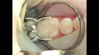 How to restore the difficult Class II with Composite [upl. by Liahkim]