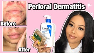 HOW I CLEARED MY PERIORAL DERMATITIS  Affordable Products [upl. by Ozen]