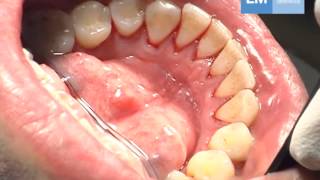 Periodontal treatment protocol [upl. by Olyhs]