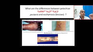 How can I differentiate between petechiae purpura and eecymosis bruises  platelet coagulation [upl. by Etnahs]