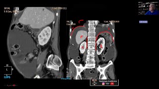 Anatomia peritoneal [upl. by Einallem958]