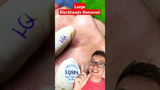 CRAZY BLACKHEAD REMOVAL  Huge Blackheads On Nose shorts [upl. by Mukund863]