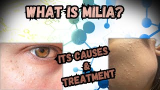 What Is Milia What Are Its Causes And Its Treatment [upl. by Eelannej]