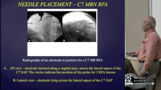 Cervical Radiofrequency Neurotomy Techniques by Mario De Pinto MD [upl. by Yvon]