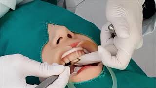 앞니레진 앞니레진 실시간 치료설명 Diastema resin closure real time anterior direct resin treatment [upl. by Chenee]