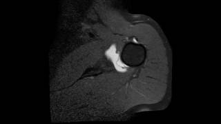 Labral tear and SLAP tear of the shoulder  complete MRI examination [upl. by Ardnauq]