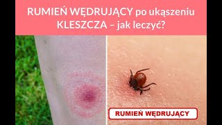 RUMIEŃ WĘDRUJĄCY po ukąszeniu KLESZCZA – jak leczyć Zdrowie 24h [upl. by Ymma574]