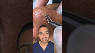 OMG I was not expecting that blackhead extraction on the nose Dr Somji reacts [upl. by Solram]