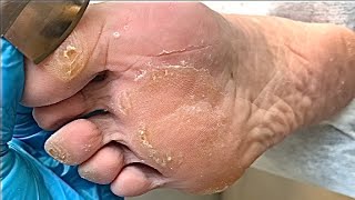 Callus removal from feetampFoot scraping dead skin【Xiao Yan pedicure】stress 19 [upl. by Stanislaus311]