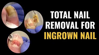 Total Nail Removal For Ingrown Toenail [upl. by Jenelle441]