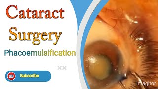 Cataract Surgery Complete With Phacoemulsification [upl. by Kroy556]